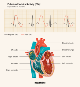 PEA on ECG