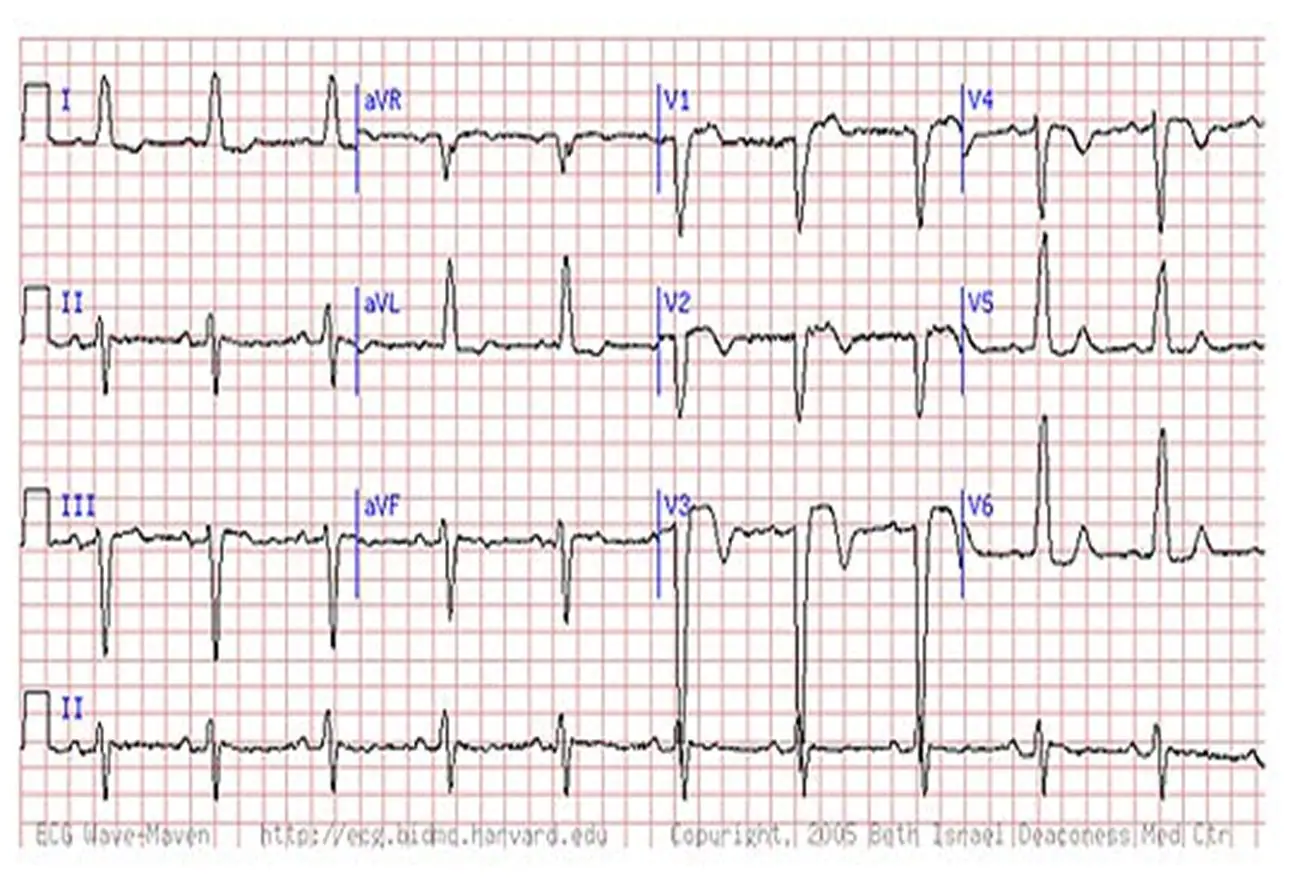健康・医学 The Ecg in Acute Mi ECG Patterns You Must Know To Acute myocardial infarctio