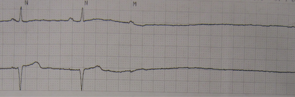What is Pulseless electrical activity vs asystole