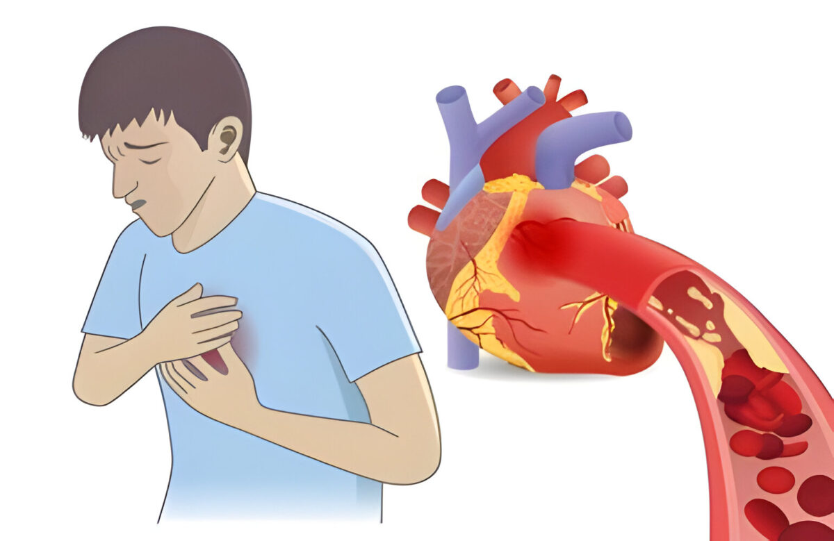 Identifying and Treating Second Degree AV Heart Block