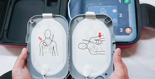 Mastering the Proper AED Pad Placement for Adults