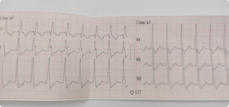 Narrow Tachycardia