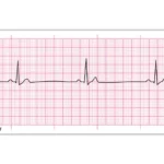 what is normal sinus rhythm and How It looks