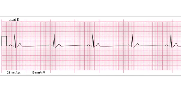 what is normal sinus rhythm and How It looks