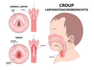 Croup Infection in Children