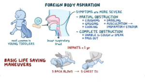 Pediatric Upper Airway Management