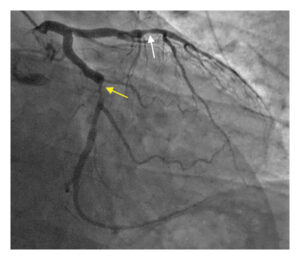 An image showing 80 percent heart blockage