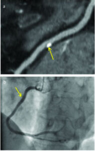An image depicting the 20-40% blockage of the right coronary artery