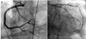 Images showing coronary arteries at the left and right side of the heart