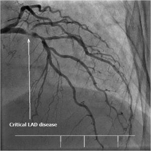An image depicting the complete occlusion or blockage of the LAD artery